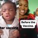 Baby now visually impaired after vaccination