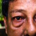 Man Loses Sight in Mozambique After Using Traditional Medicine for Conjunctivitis