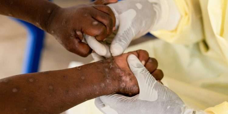 Mpox Africa WHO meets