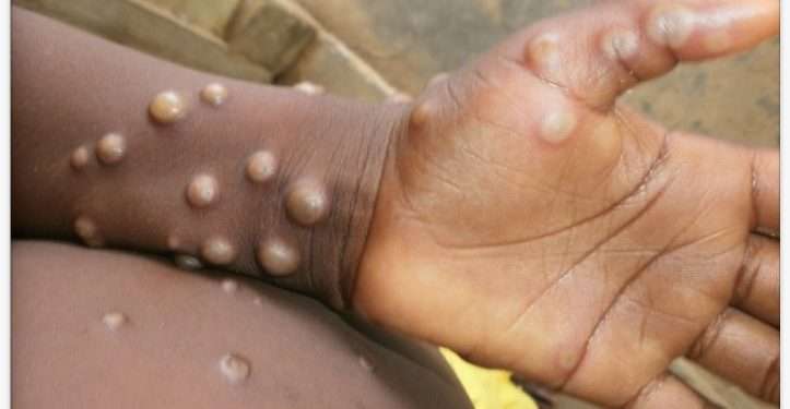 Mpox WHO