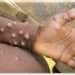 Mpox WHO
