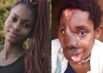 Mbah Median before and after she was attacked and short in Cameroon's Anglophone Region. Here is her story.