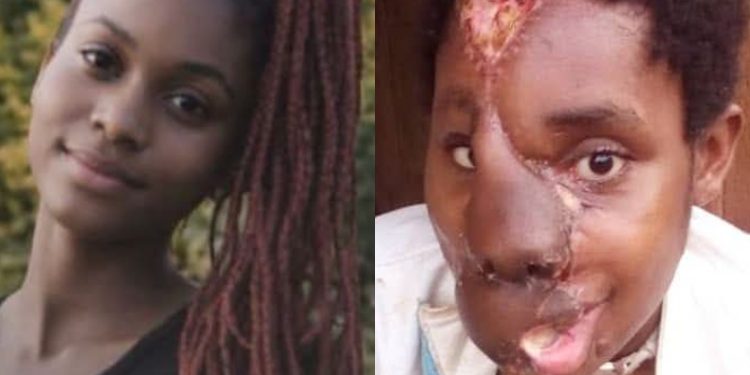 Mbah Median before and after she was attacked and short in Cameroon's Anglophone Region. Here is her story.