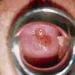 M8500180 Cervical Cancer Science Photo Library High Fr