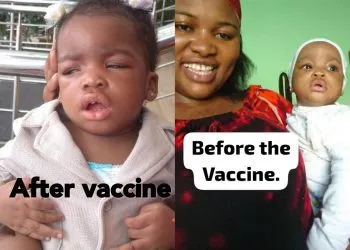 Baby now visually impaired after vaccination