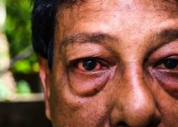 Man Loses Sight in Mozambique After Using Traditional Medicine for Conjunctivitis