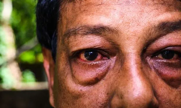 Man Loses Sight in Mozambique After Using Traditional Medicine for Conjunctivitis