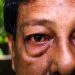 Man Loses Sight in Mozambique After Using Traditional Medicine for Conjunctivitis