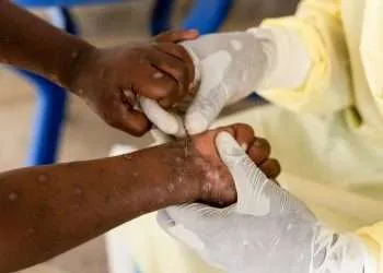 Mpox Africa WHO meets