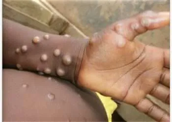 Mpox WHO