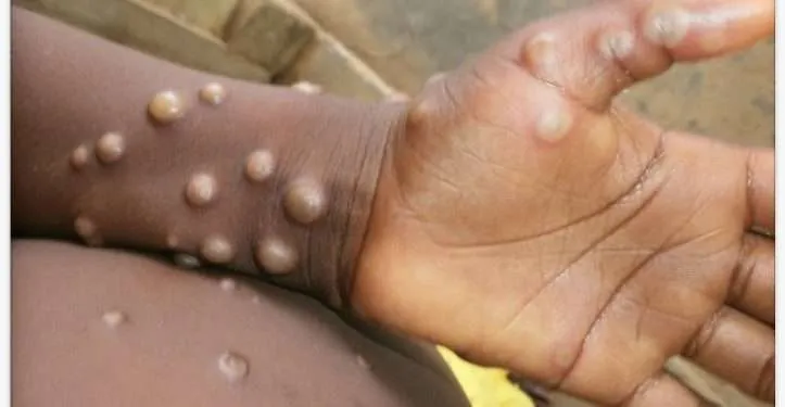 Mpox WHO