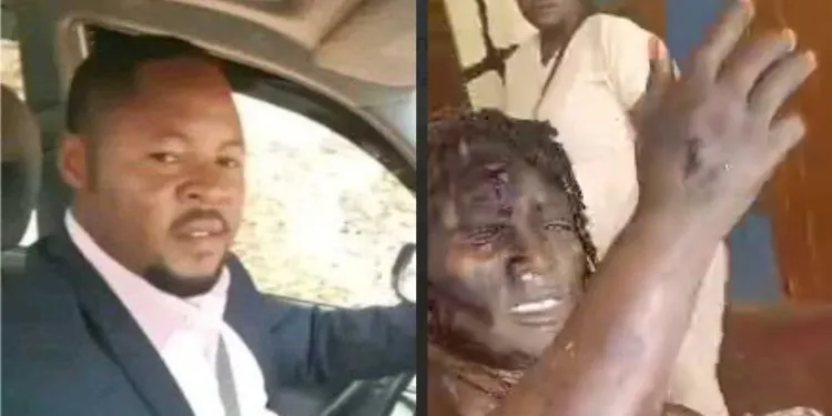 Man pours acid on the wife Bamenda